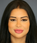 Feel Beautiful - Rhinoplasty 223 - Before Photo